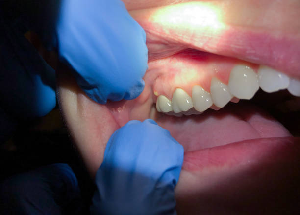 Best Emergency Tooth Extraction in Centerville, MN