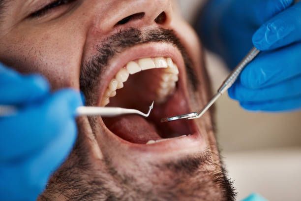 Best Emergency Tooth Extraction in Centerville, MN